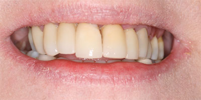 Closeup of Alexia's smile, an actual patient of Beaverton dentist Dr. Montrose