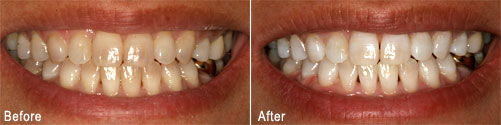 Before and after teeth whitening in Beaverton with the dentists at Smiles Northwest