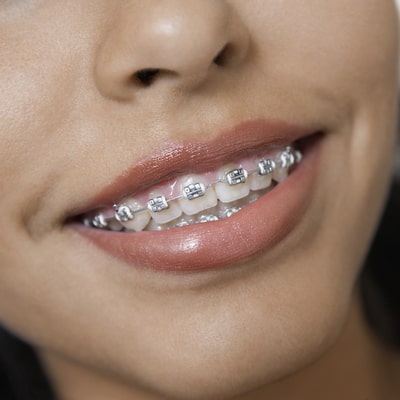 Closeup of a young person's smile with metal braces to show that Invisalign in Beaverton, OR do not use metal