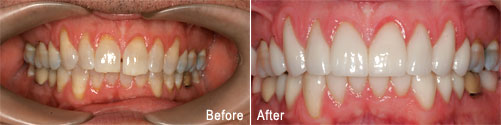 Closeup of a patient's smile before and after dental treatment